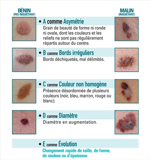 Par quels oeufs déduisaient les taches de rousseur