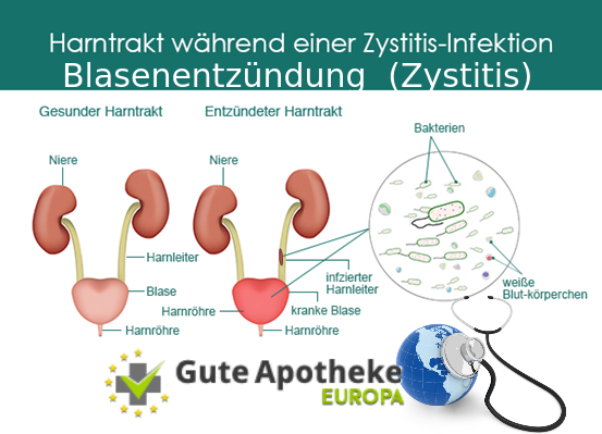 Blasenentzündung (Zystitis)