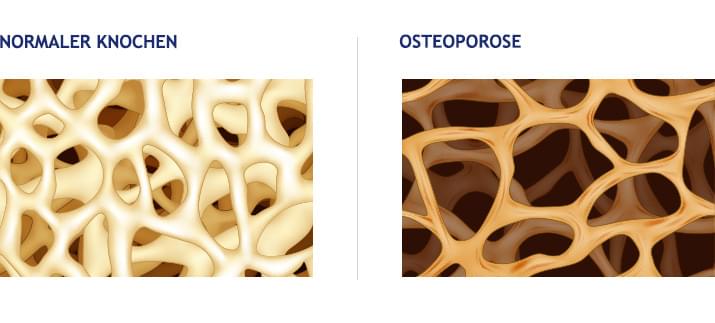 Osteoporose 