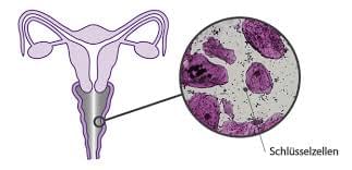 bakterielle Vaginose