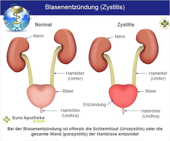  Blasenschwäche