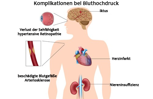 Bluthochdruck