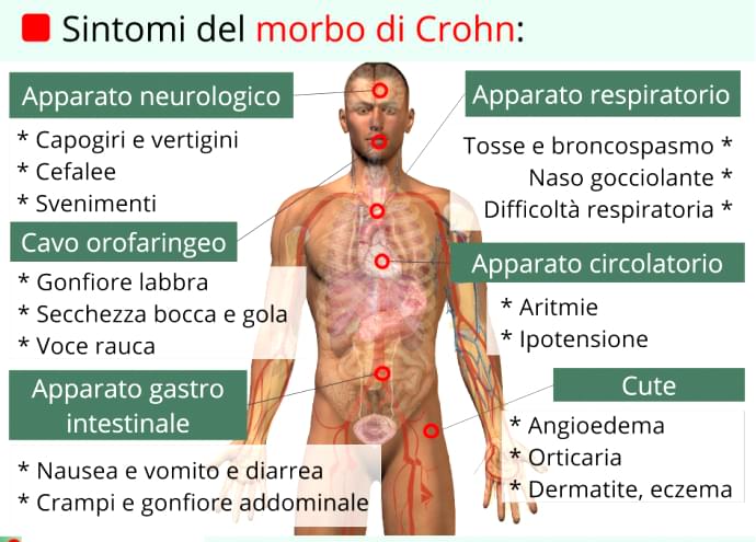 La morbo di Crohn